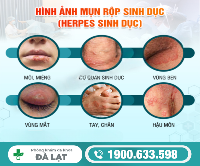 CÁCH CHỮA MỤN RỘP VÙNG KÍN Ở NAM VÀ NỮ 